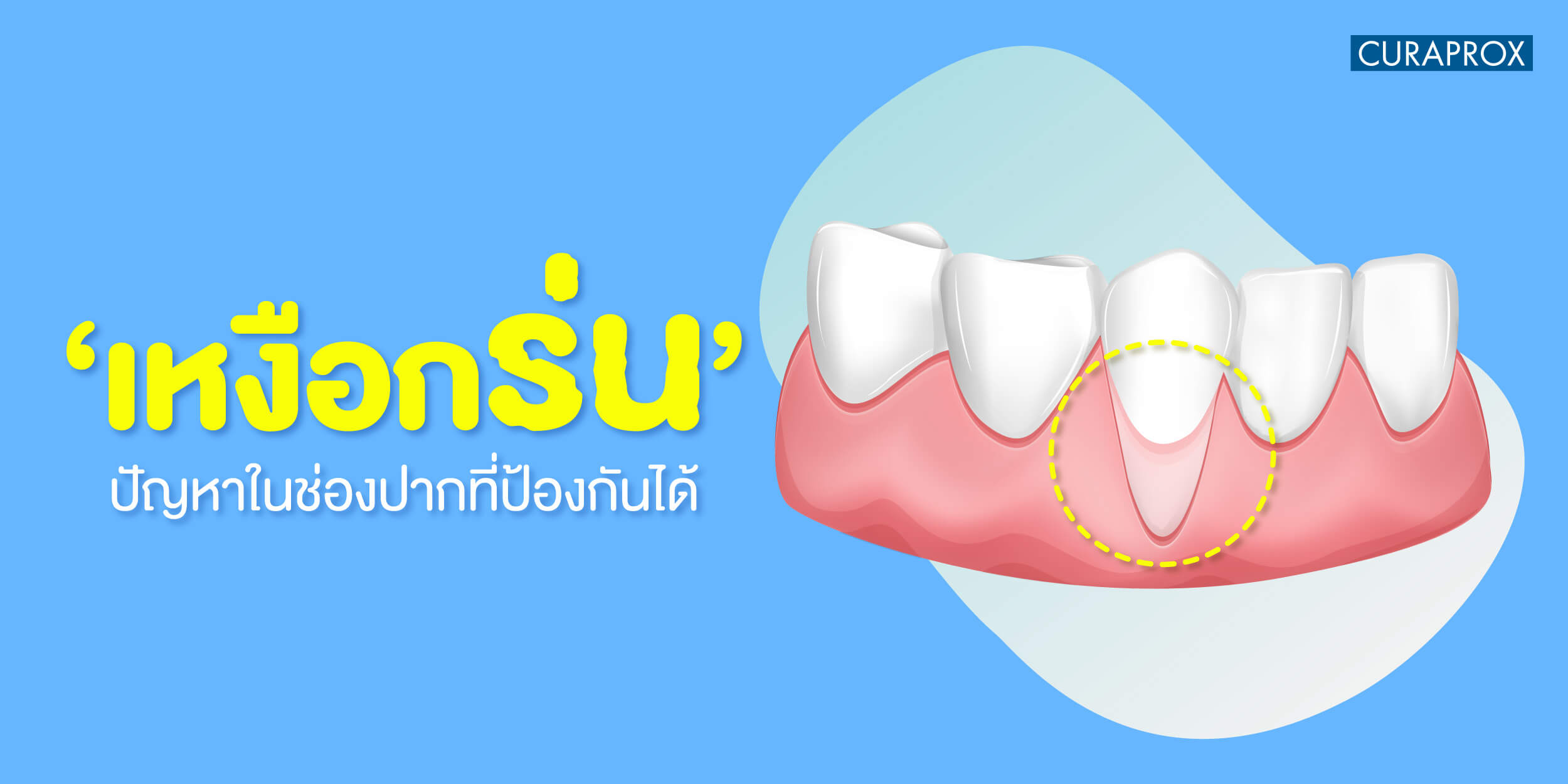 รักษาเหงือกร่น