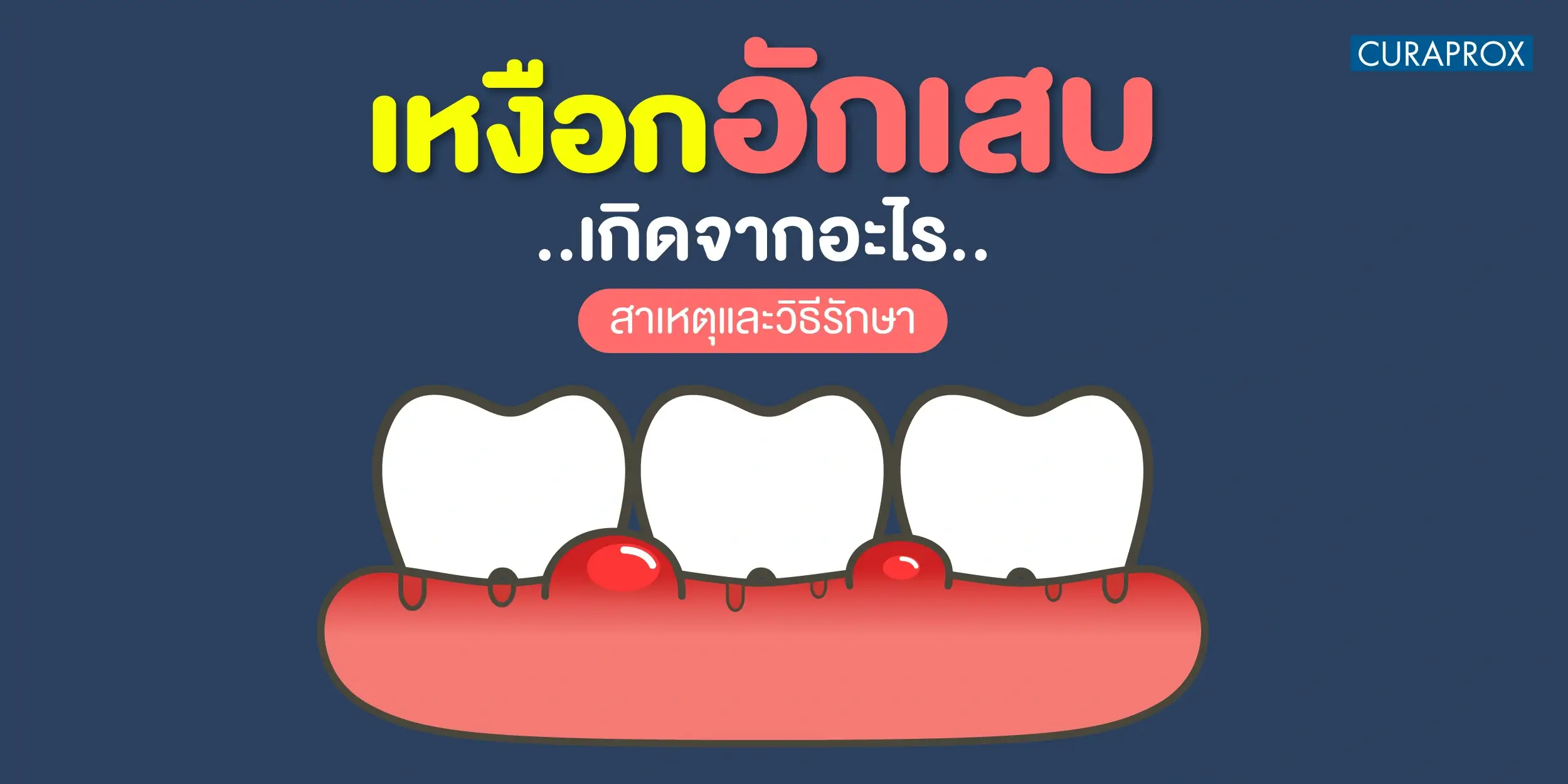 เหงือกอักเสบ