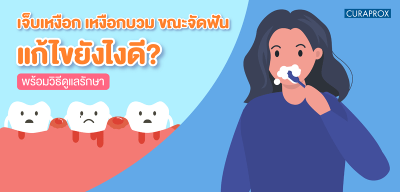 เหงือกบวม จัดฟัน