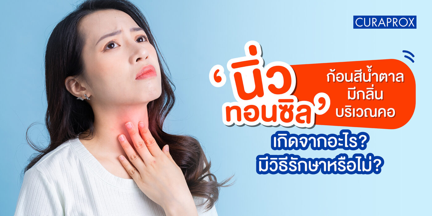 นิ่วทอนซิล หรือ ทอนซิลสโตน ก้อนสีน้ำตาลมีกลิ่นบริเวณคอเกิดจากอะไร มีวิธีรักษาหรือไม่
