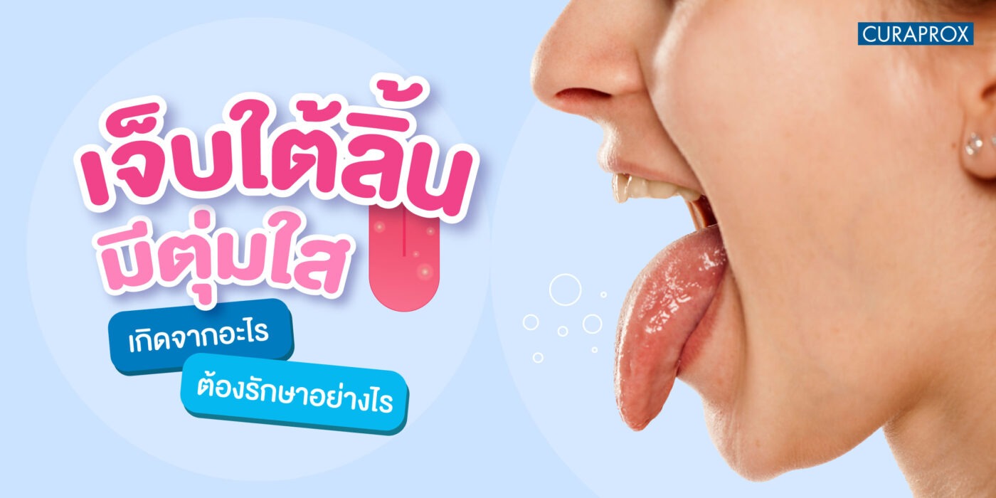 เจ็บใต้ลิ้น มีตุ่มใสเกิดจากอะไร ต้องรักษาอย่างไร