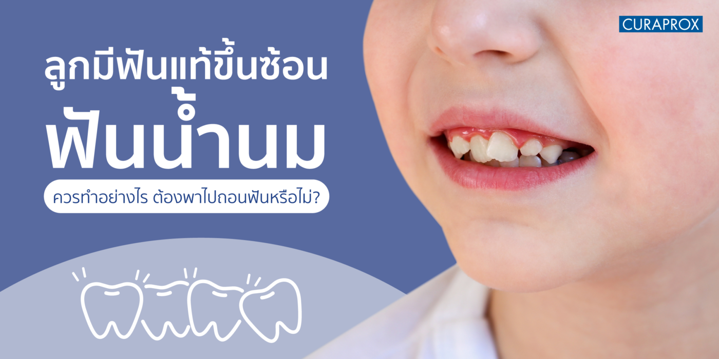 ลูกมีฟันแท้ขึ้นซ้อนฟันน้ำนม ควรทำอย่างไร ต้องพาไปถอนฟันหรือไม่?