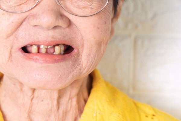 ผลเสียจากปัญหาสุขภาพช่องปาก และฟันของผู้สูงอายุ